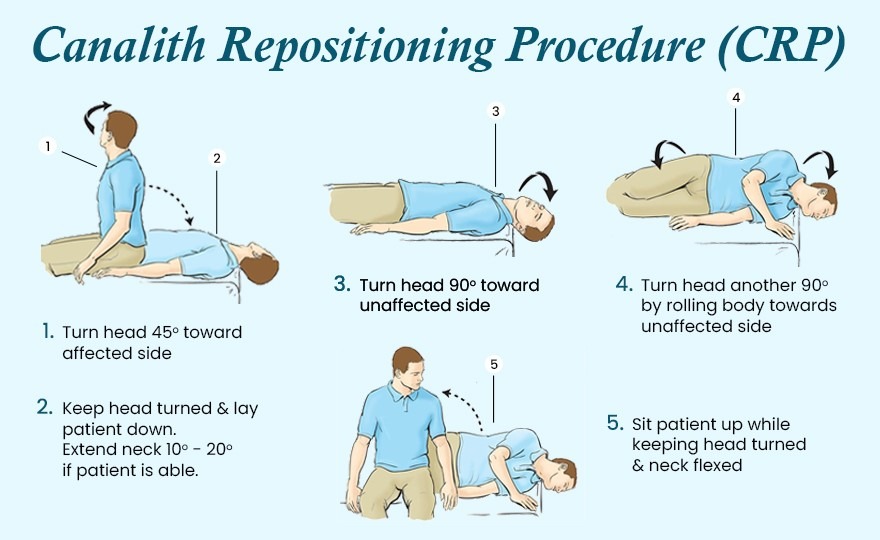 vertigo exercises
